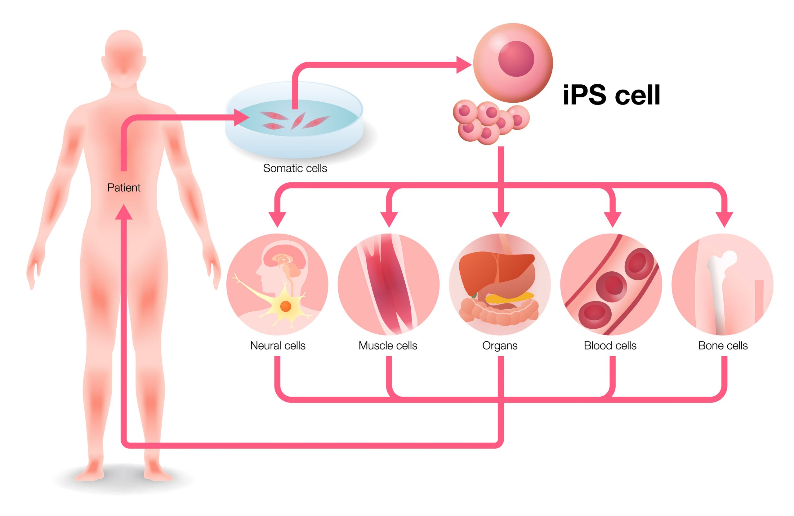 Células madre pluripotenciales inducidas (iPSCs) usando bioimpresión